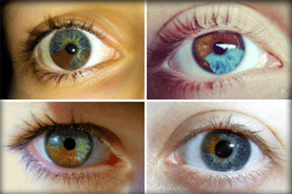Do you have heterochromia?