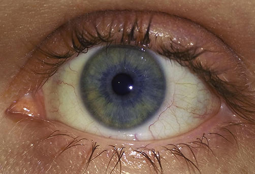 Do you have heterochromia?