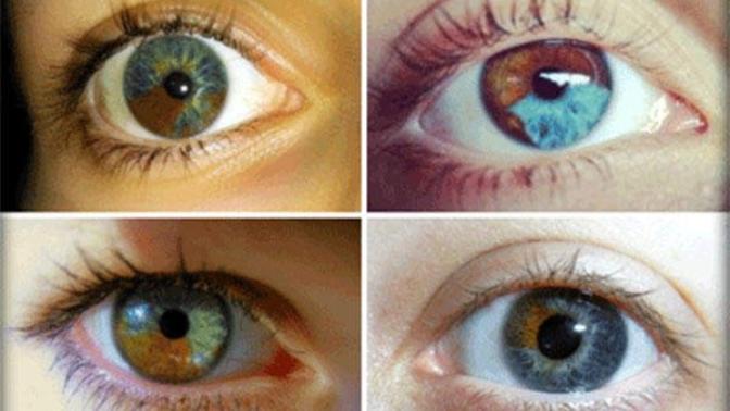 Do you have heterochromia?