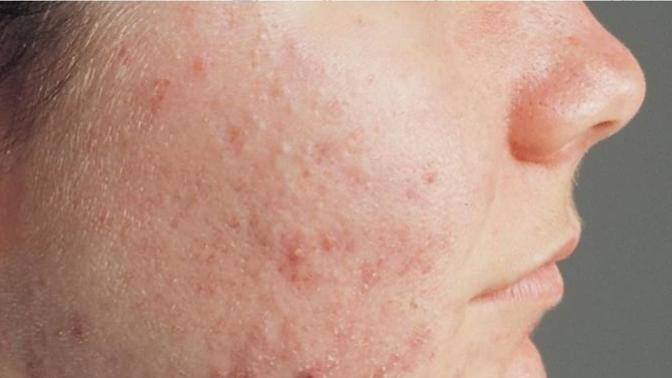 Would bad acne be a reason not to date someone for you?
