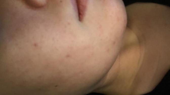 What type of acne does it look like I have? how can I fix it?