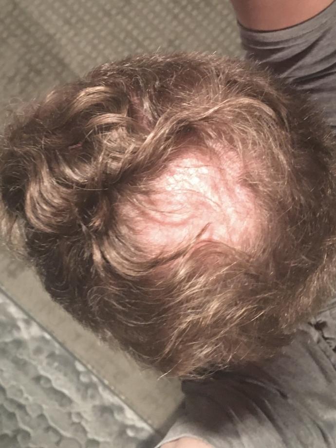 Im 41 and the crown of my head is going bald. Shave or not? Or?