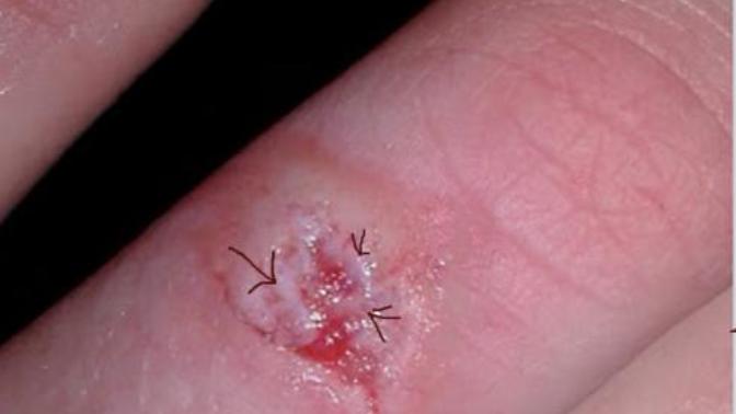Yesterday I cut my finger REALLY badly and today I noticed that some of the skin around the cut had turned white. Should I be worried?