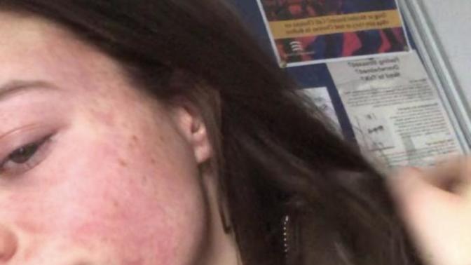 What are these blotchy red marks on my face?