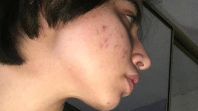 How to get rid of my acne?