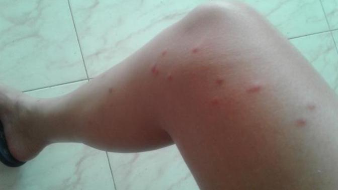 Are these mosquito Bites or something else?