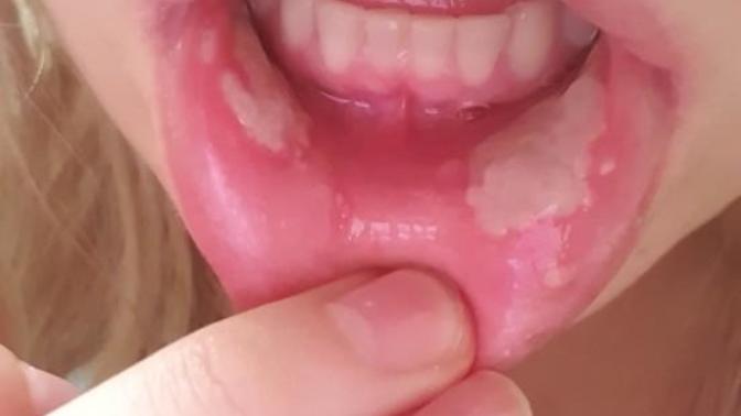 Chewed the hell out of my gums 2 days ago at a festival and now have huge blisters in my mouth... Will a doctor judge me or should I lie?