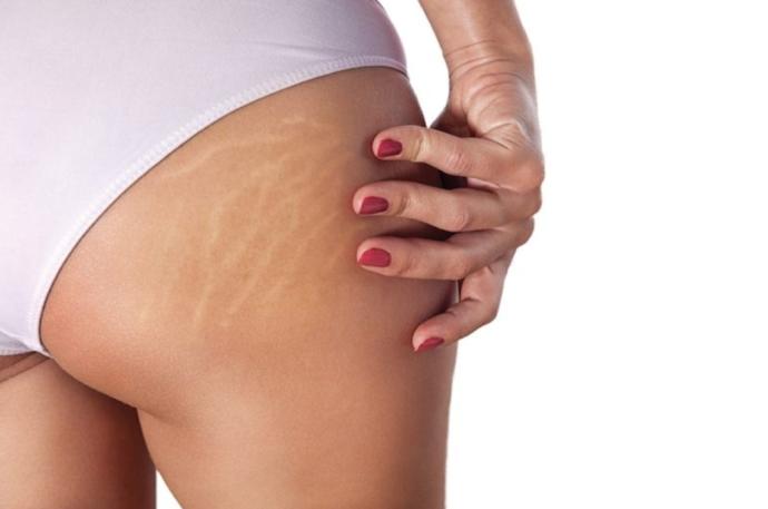 Do guys care about stretch marks/loose skin?