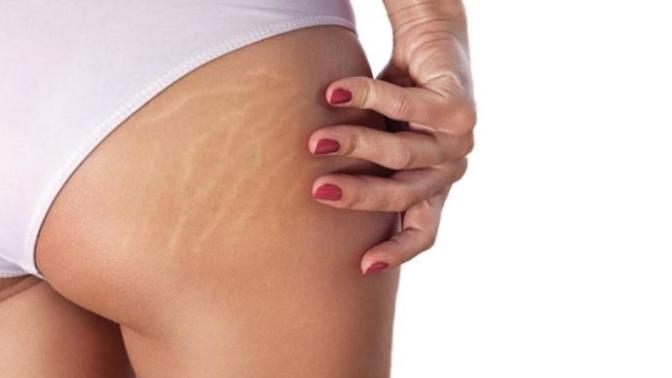 Do guys care about stretch marks/loose skin?