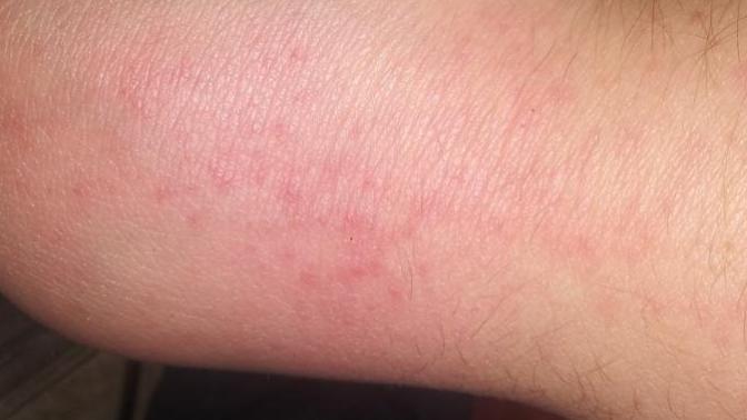 I have this rash on my right hand what could it be?