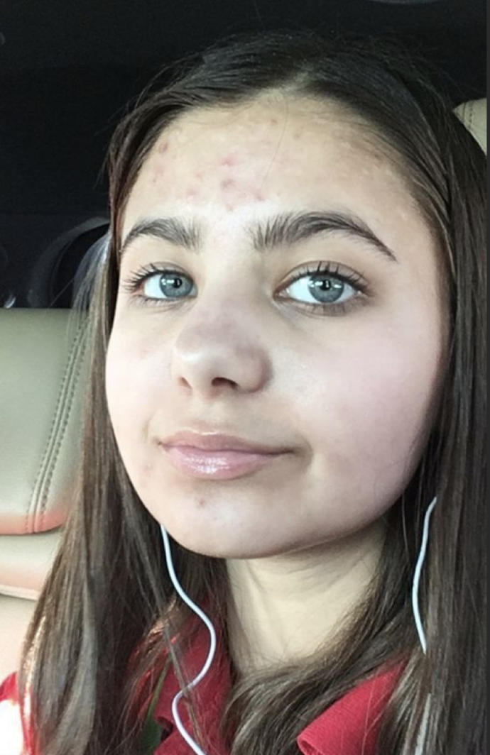 Do you care if a girl has perfect skin or acne?