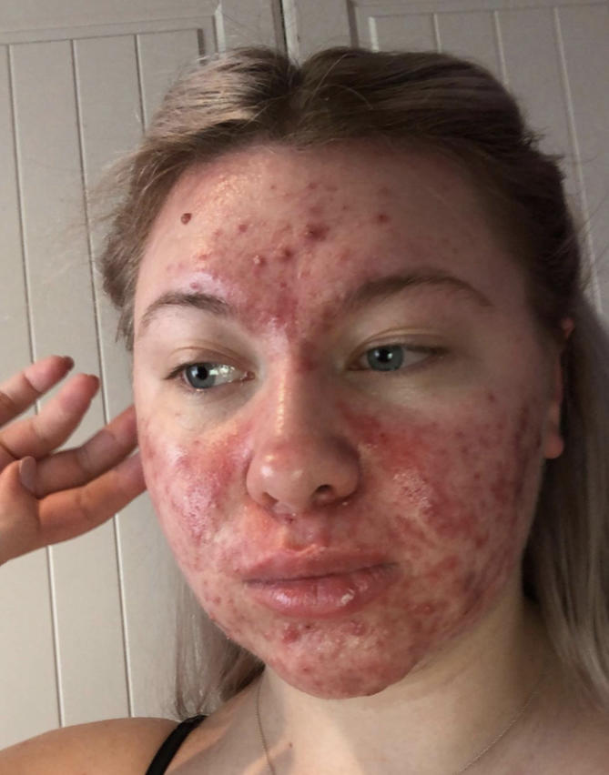 Do you care if a girl has perfect skin or acne?