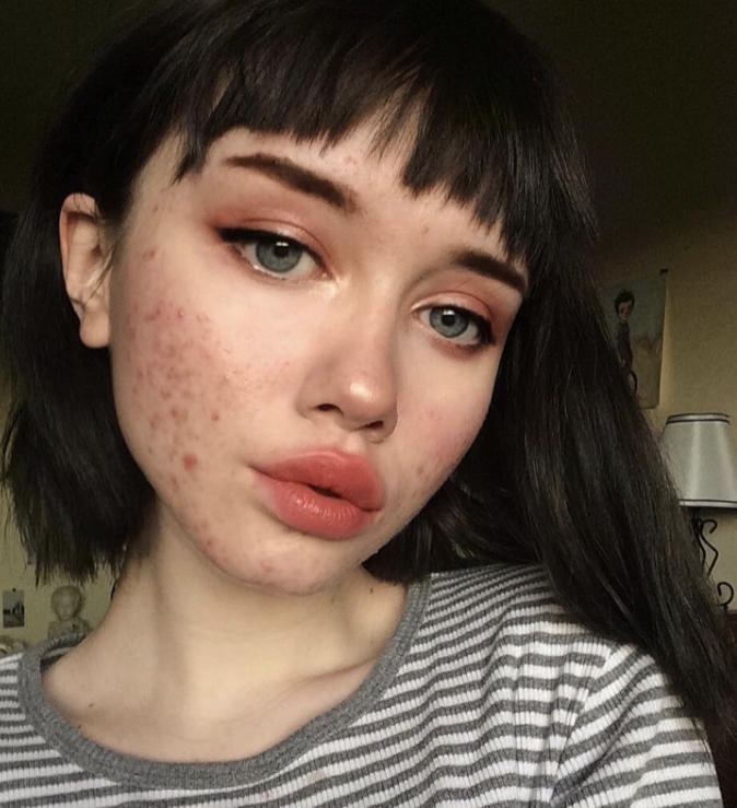 Do you care if a girl has perfect skin or acne?