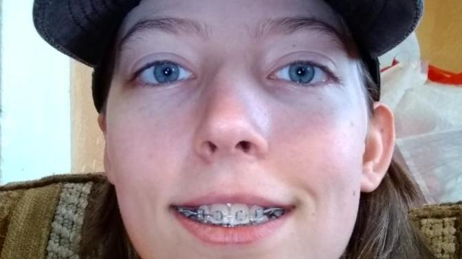 What are braces generally made of for to keep teeth aligned correctly?