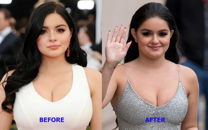 Guys, if your girlfriend wanted breast reduction surgery (and she qualified), would you support her decision?