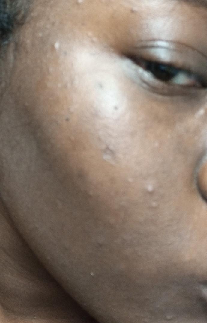 Is acne a turn off?