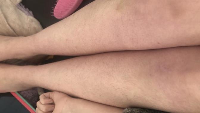 Does anyone know why the skin of my legs are purple and dotty?