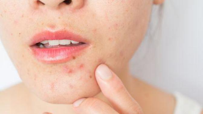Anyone know how to treat hormonal acne?