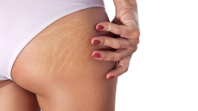 Do guys care about stretch marks?