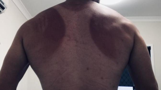 Any sunburn remedies?