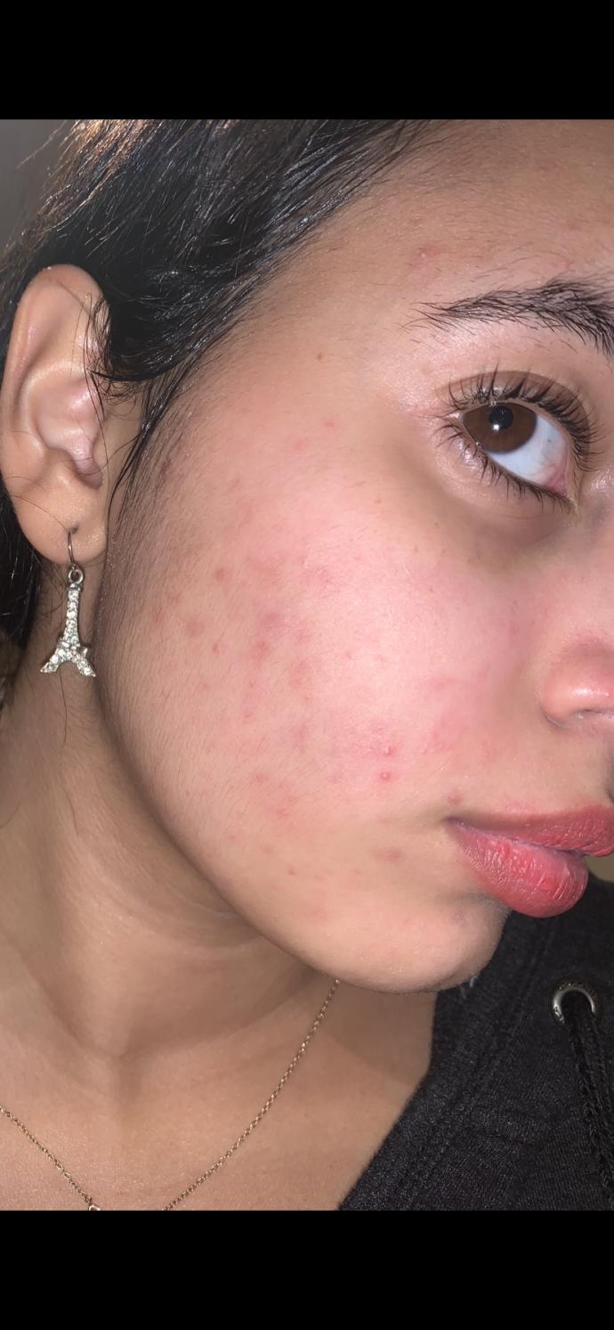 Ignore the acne, Do you find this facial hair too much for a girl?