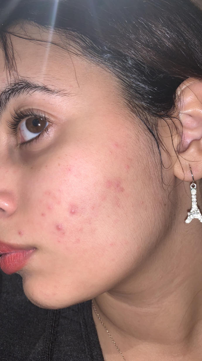 Ignore the acne, Do you find this facial hair too much for a girl?