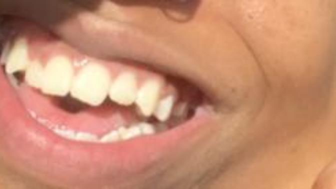 Do guys notice/care when a girl has crooked teeth?