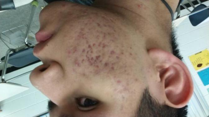 How to get rid of acne scars?