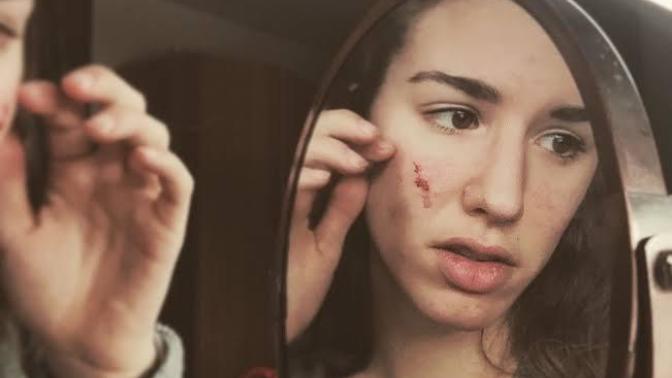 Would you date someone with Excoriation Disorder (Skin Picking Or Dermatillomania?