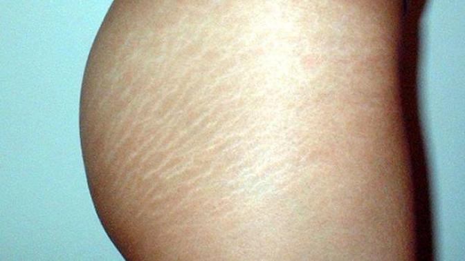Do guys care about stratch marks?