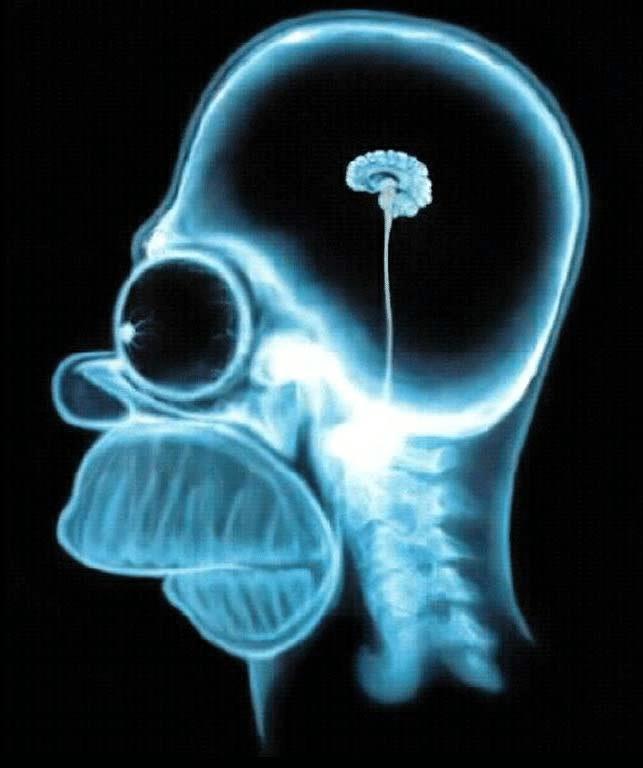 Homer Simpsons measly brain in MRI. Help a fella out, would ya?