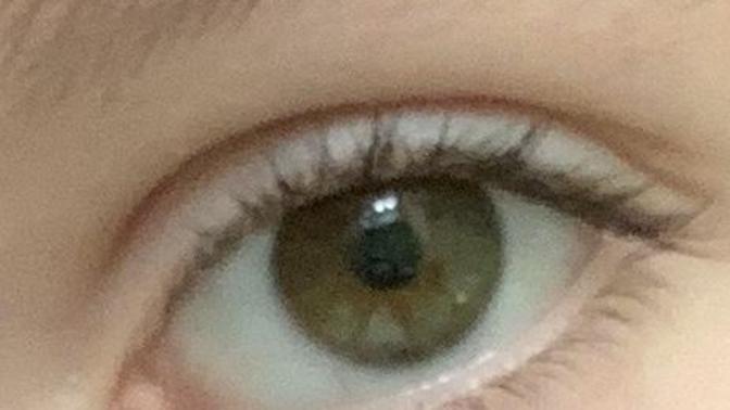 Do I have distichiasis?