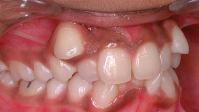 Do you think people who get braces are deceiving future S. O?