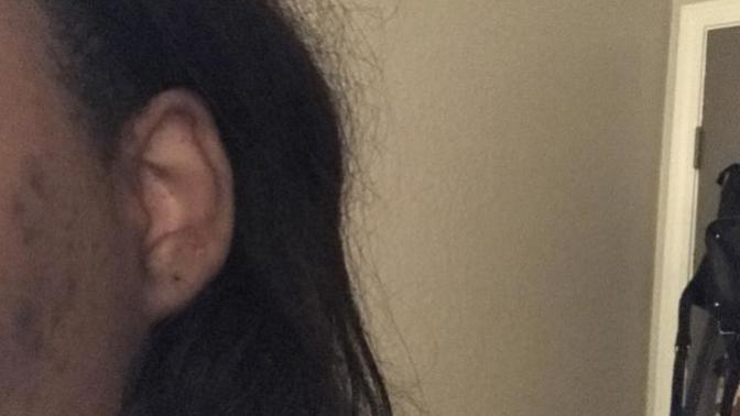 Is it possible to get cosmetic surgery for bigger ears?