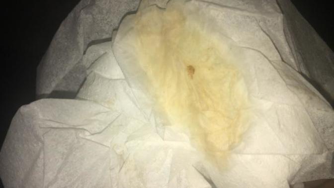Is this brown discharge normal during pregnancy?
