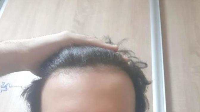 Am I receding at my 18's?