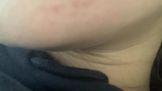 Reasons why I’m getting adult acne and what products can I use (pic)?
