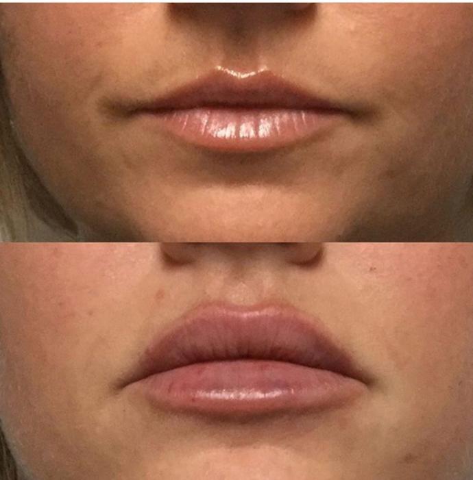 Lip fillers