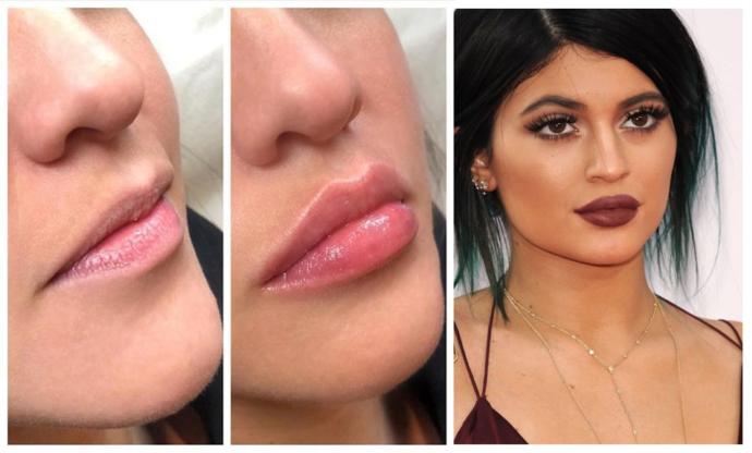 Also lip fillers