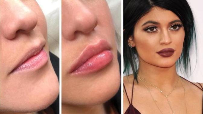 What do you think about lip fillers?