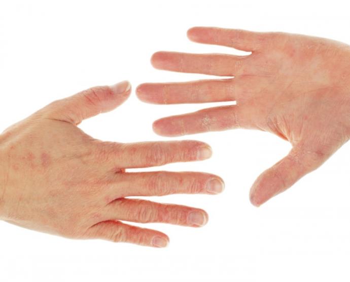 Best Dry Hands Treatment?