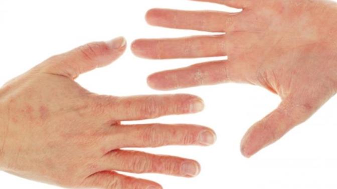 Best Dry Hands Treatment?