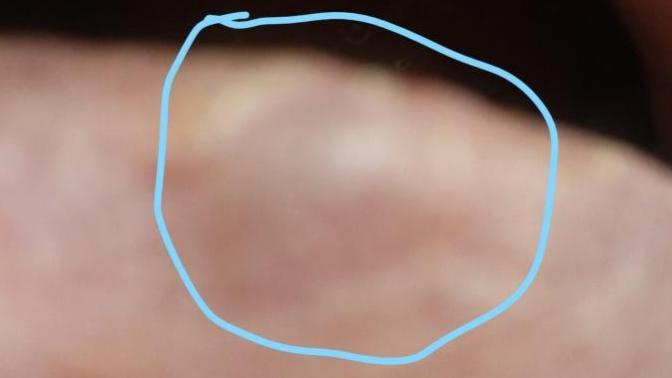 Is this thing a venous lake?