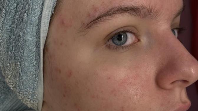 Does anyone know what causes/what can fix this kind of acne?