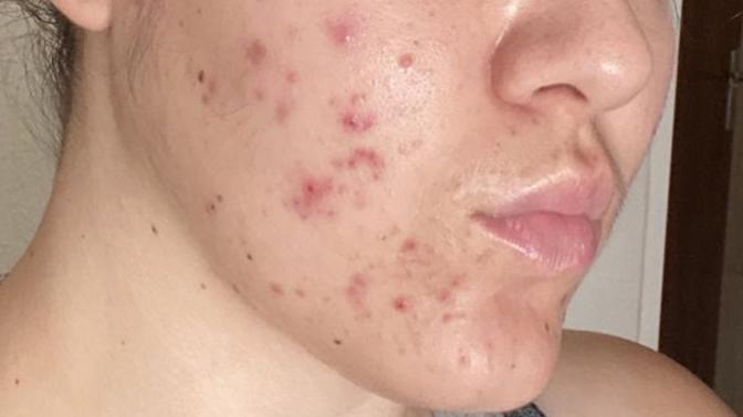 PLEASE help me with my skin?