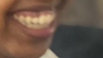 Insecurity because of my gummy smile?