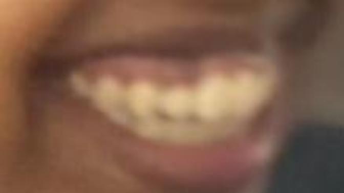Insecurity because of my gummy smile?