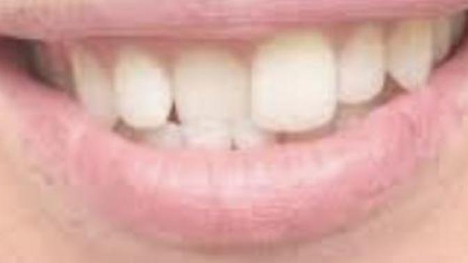 Would you overlook crooked teeth on a date?