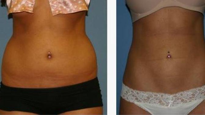 Would you get a liposuction if you will get suck results?