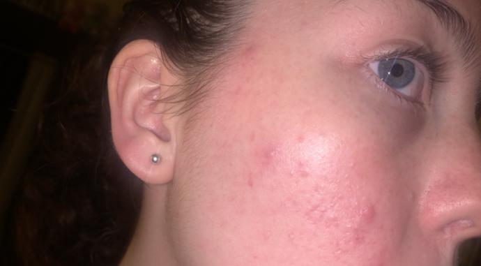 Is this acne, pimples, or scarring?